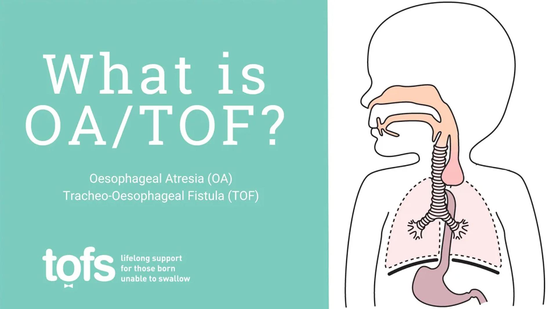 What is OA/TOF? Oesophageal Atresia (OA) Tracheo-Oesophageal Fistula (TOF)